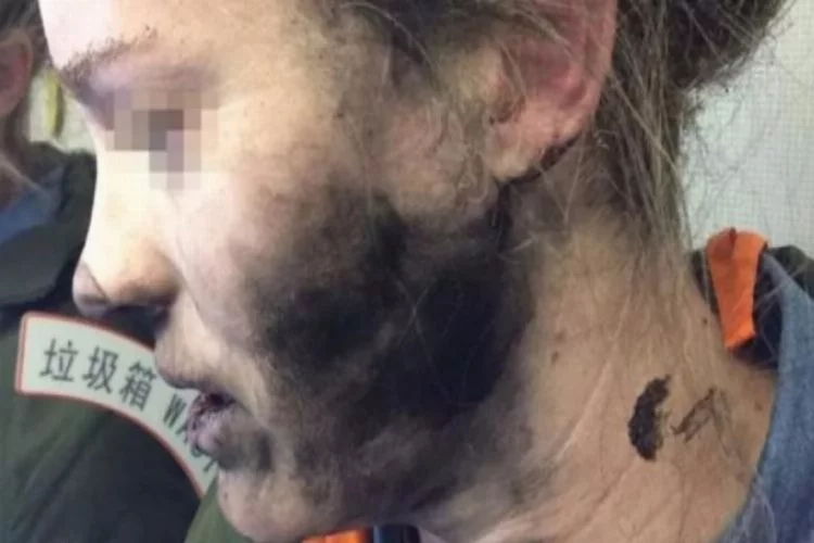 Genç kadın dehşeti yaşadı! Yüzünde patladı