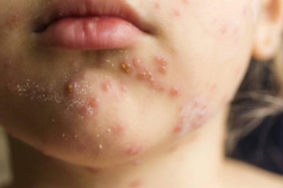 Kızamık ölümleri son yılda yüzde 40 arttı!