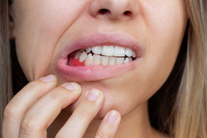 Diş problemleri, şeker hastalığını tetikleyebilir