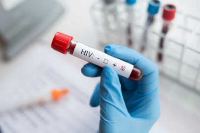 Aids nedir? Nasıl tedavi edilir?
