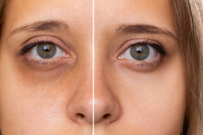 Evde göz altı morlukları en hızlı nasıl geçer?