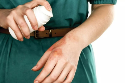 Yanık tedavisinde dikkat etmemiz gerekenler nelerdir?