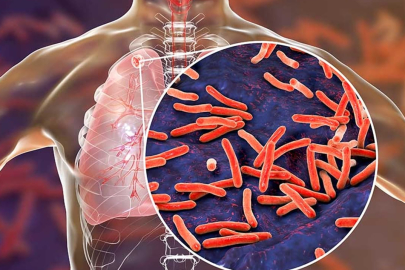 Verem (Tüberküloz): Tanım, nedenleri ve tedavi