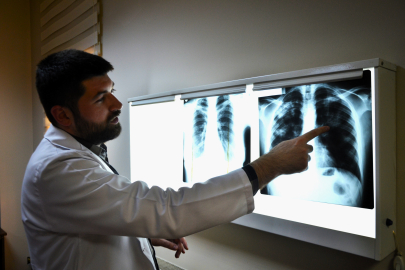 “Verem (Tüberküloz) sadece akciğerde görülmüyor”