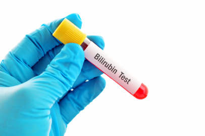 Bilirubin nedir, yüksekliği neden olur?