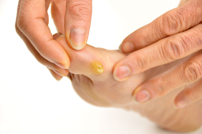 Nasır nedir? Nasıl oluşur?