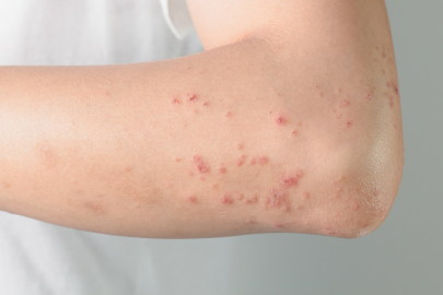 Behçet hastalığı tehlikeli midir? Behçet hastalığının belirtileri nelerdir?