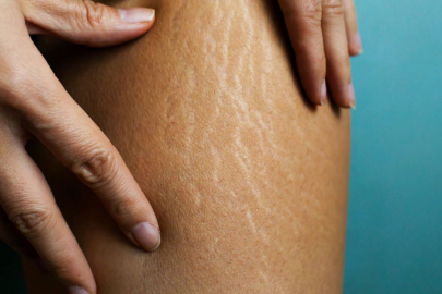 Selülit nasıl geçer? Selülit geçiren yöntemler, püf noktaları nelerdir?