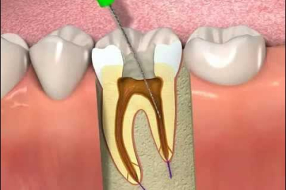 Kanal tedavisi nedir? Kanal tedavisi nasıl yapılır?