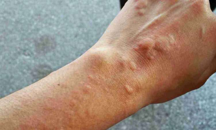 Arı sokmasına ne iyi gelir? Bursa Hayat Gazetesi-3