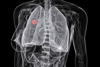 Kadınlarda akciğer kanseri alarmı: Vakalar artıyor!