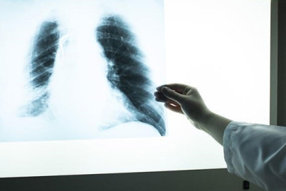 Pasif içicilerde yüksek "akciğer kanseri" riski