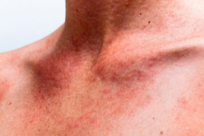 Güneş Alerjisi (Güneş Yanığı): Nedenleri, belirtileri ve doğal çözümleri