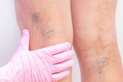 Ödem: Vücutta su birikmesi ve çözüm yolları