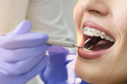 Diş teli tedavisi nasıl yapılır?