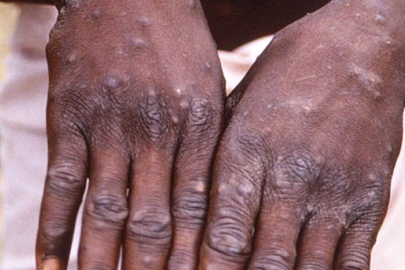 Maymun Çiçeği salgını kapıda mı?