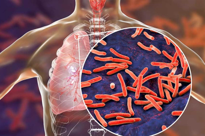 Tüberküloz nedir ve belirtileri nelerdir?