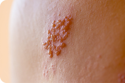 Zona nedir, tehlikeli mi?