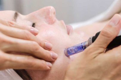 Mezoterapi nedir ve ne işe yarar?