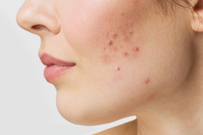 Yetişkinlerde akne: Nedenleri ve çözümleri