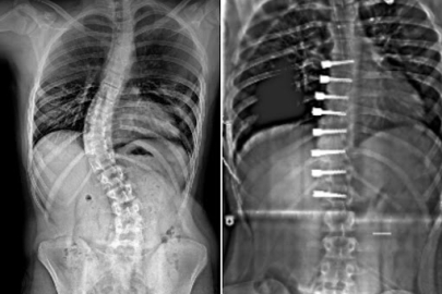 Skolyoz ve yaşam kalitesi: Fiziksel ve psikolojik etkiler