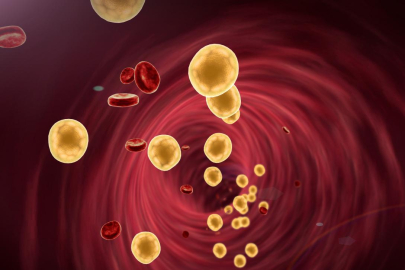 Dislipidemi: Nedir, nedenleri, belirtileri ve tedavi yöntemleri