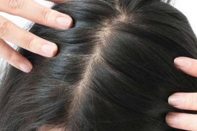 Saçların kabusu: Kepek ve dökülmenin nedenleri ve çözümleri