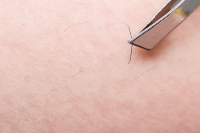 Kıl dönmesi neden olur?