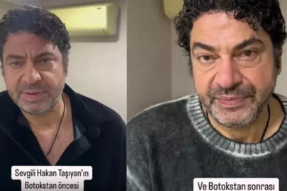Hakan Taşıyan'dan yeni görünüm: botoks yaptırdı