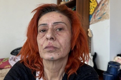 Yıldız Tilbe saç boyası nedeniyle talihsiz bir kaza geçirdi