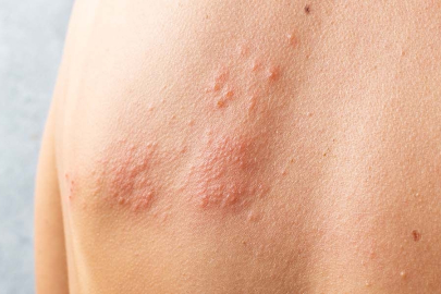 Bahar aylarında artıyor! Uzmanlar uyardı