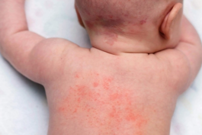 Dr. Sözer Sarıoğlu’ndan isilik uyarısı!