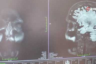 Nöroloji Uzmanı Prof. Dr. Demir: ‘MS, genç erişkinleri etkileyen bir hastalık’