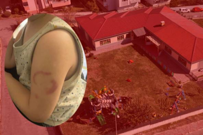 Kreşte akılalmaz olay: Öğretmen 3 yaşındaki çocuğu ısırdı