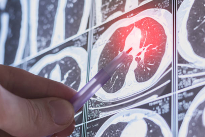 Akciğer kanseri riskleri ve koruyucu önlemler: Uzmanından önemli uyarılar