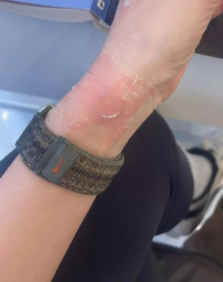 Dizi setinde talihsiz kaza! Elinde ağır yanık oluştu -Bursa Hayat-3