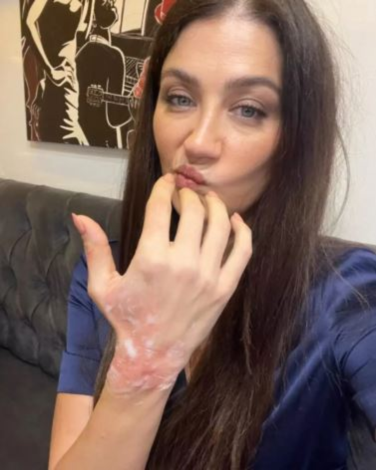 Dizi setinde talihsiz kaza! Elinde ağır yanık oluştu -Bursa Hayat-2