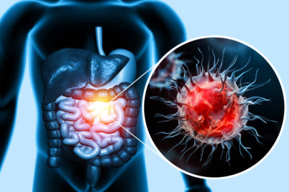 Bursa’da uzmanında önemli çağrı: Kolorektal kanser erken tanıyla önlenebilir