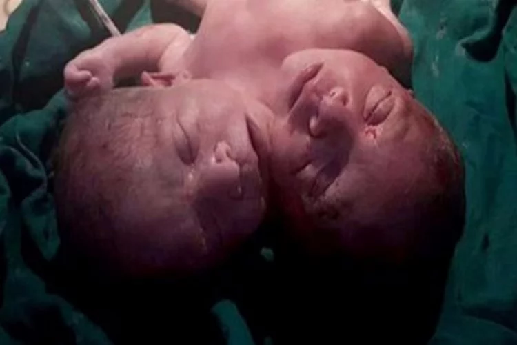İki başlı bebek dünyaya geldi