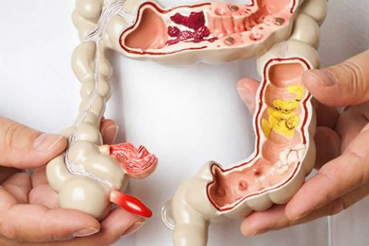 Crohn hastalığı: Nedir ve nasıl beslenmeliyiz?