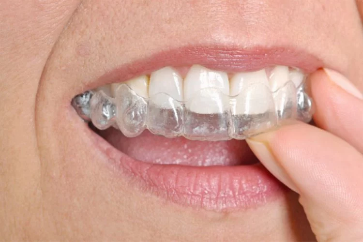 Diş teline karşı alternatif: Şeffaf plak