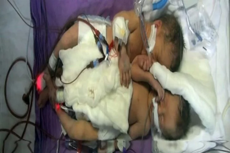 Türkiye'de ikiz siyam bebeklerin ayrılması bekleniyor